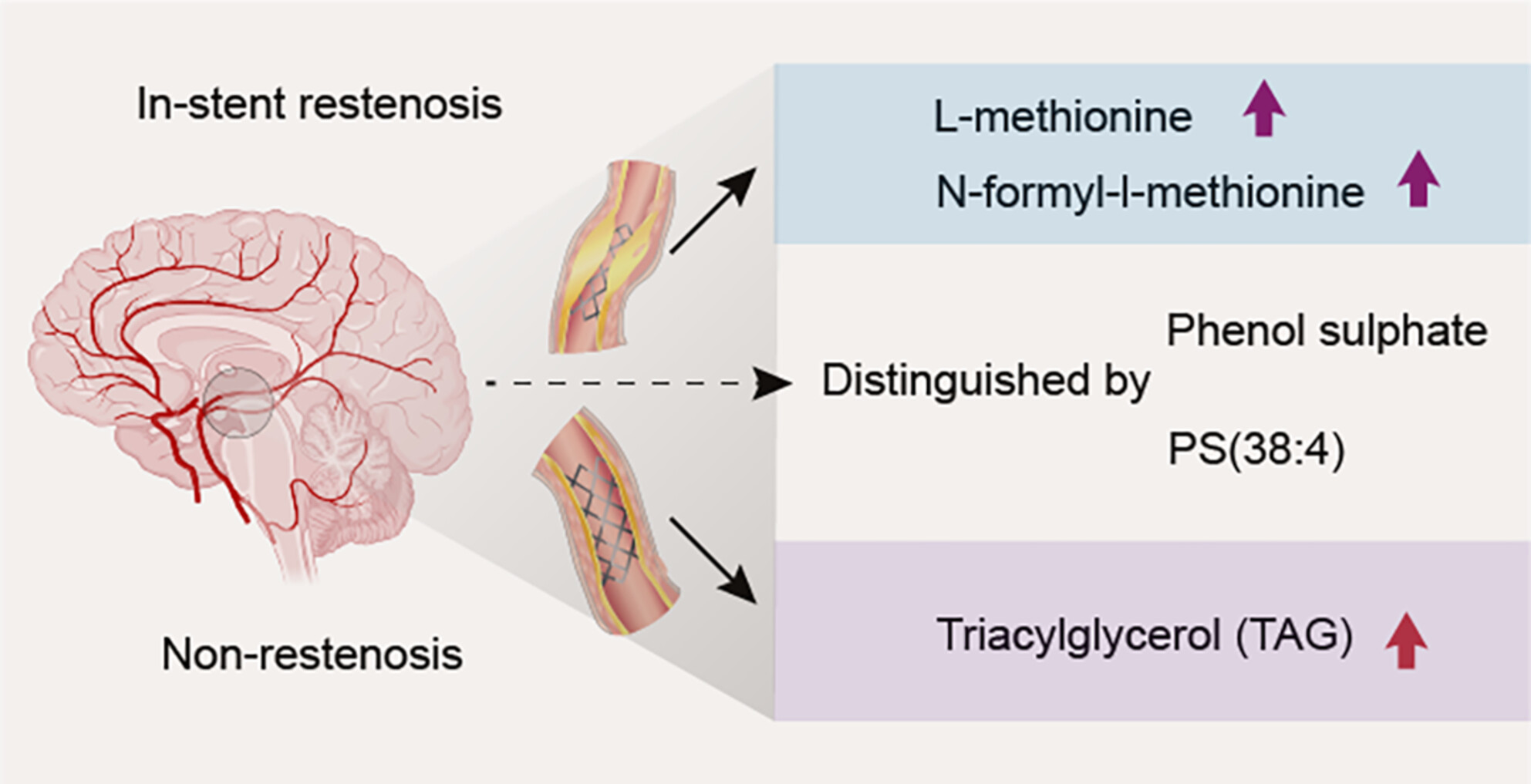 Alterations in metabolome and lipidome in patients with in-stent restenosis