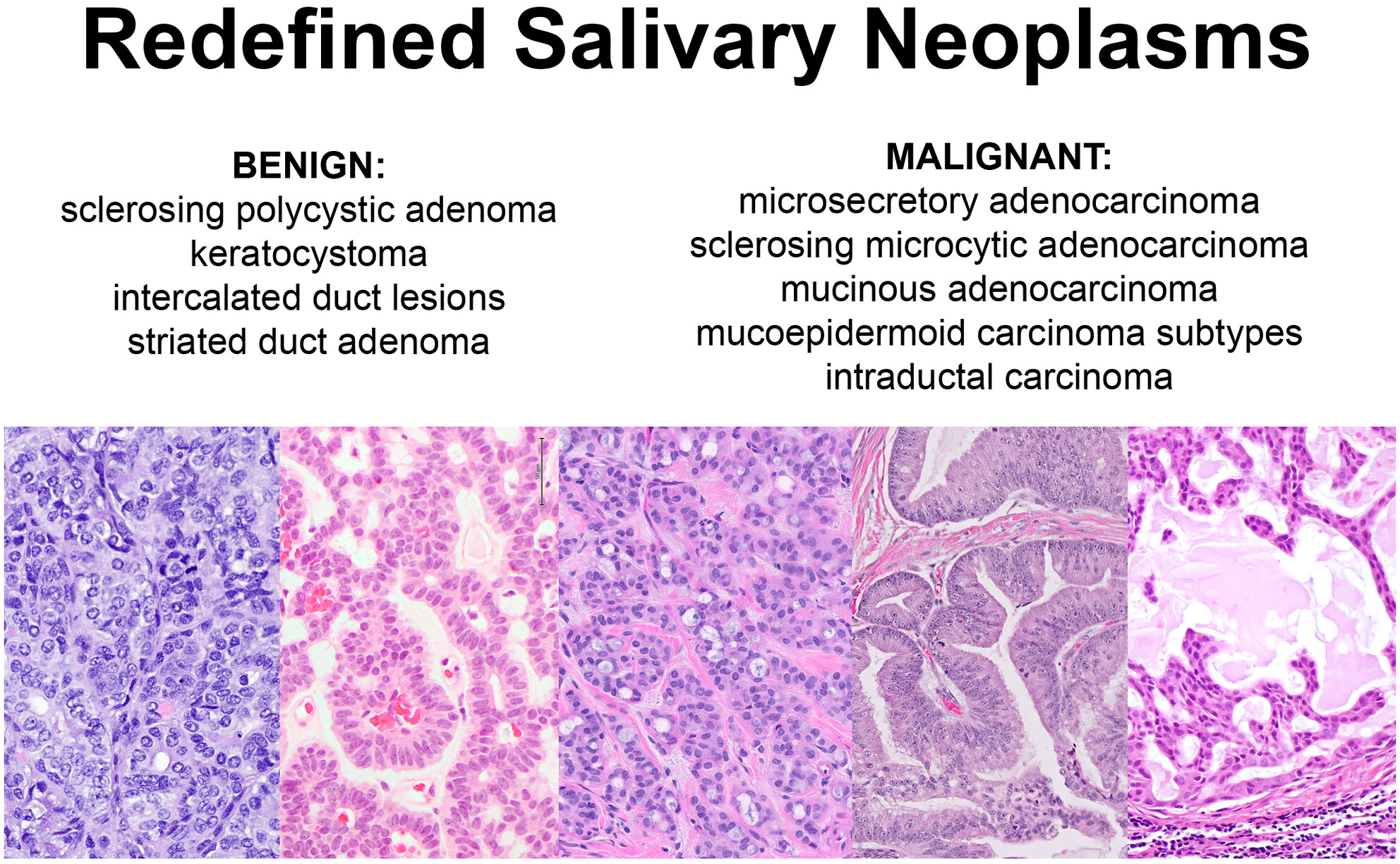 Update of newly-recognized salivary gland neoplasms: molecular and immunohistochemical findings and clinical importance