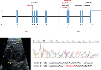 Variable cardiovascular phenotypes associated with SMAD2 pathogenic variants
