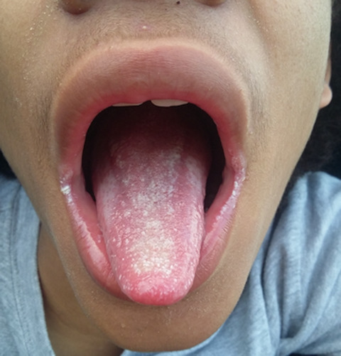 Immunologic characterization of patients with chronic mucocutaneous candidiasis disease