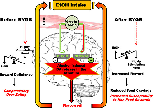 The gut in the brain: the effects of bariatric surgery on alcohol consumption