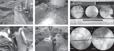 Percutaneous Robot-Assisted versus Freehand S2 Iliosacral Screw Fixation in Unstable Posterior Pelvic Ring Fracture