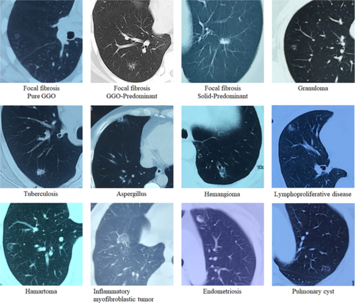 Clinical characteristics of resected solitary ground-glass opacities: Comparison between benign and malignant nodules