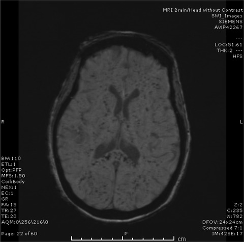 Neurologic recovery in systemic nontraumatic fat embolism syndrome in an elderly patient with hemoglobin SC disease: A case report