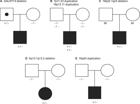 Rare copy number variants contribute pathogenic alleles in patients with intestinal malrotation