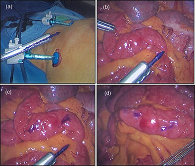 How to do safe intracorporeal marking of structures during minimally invasive surgery by simple modification of a skin marking pen