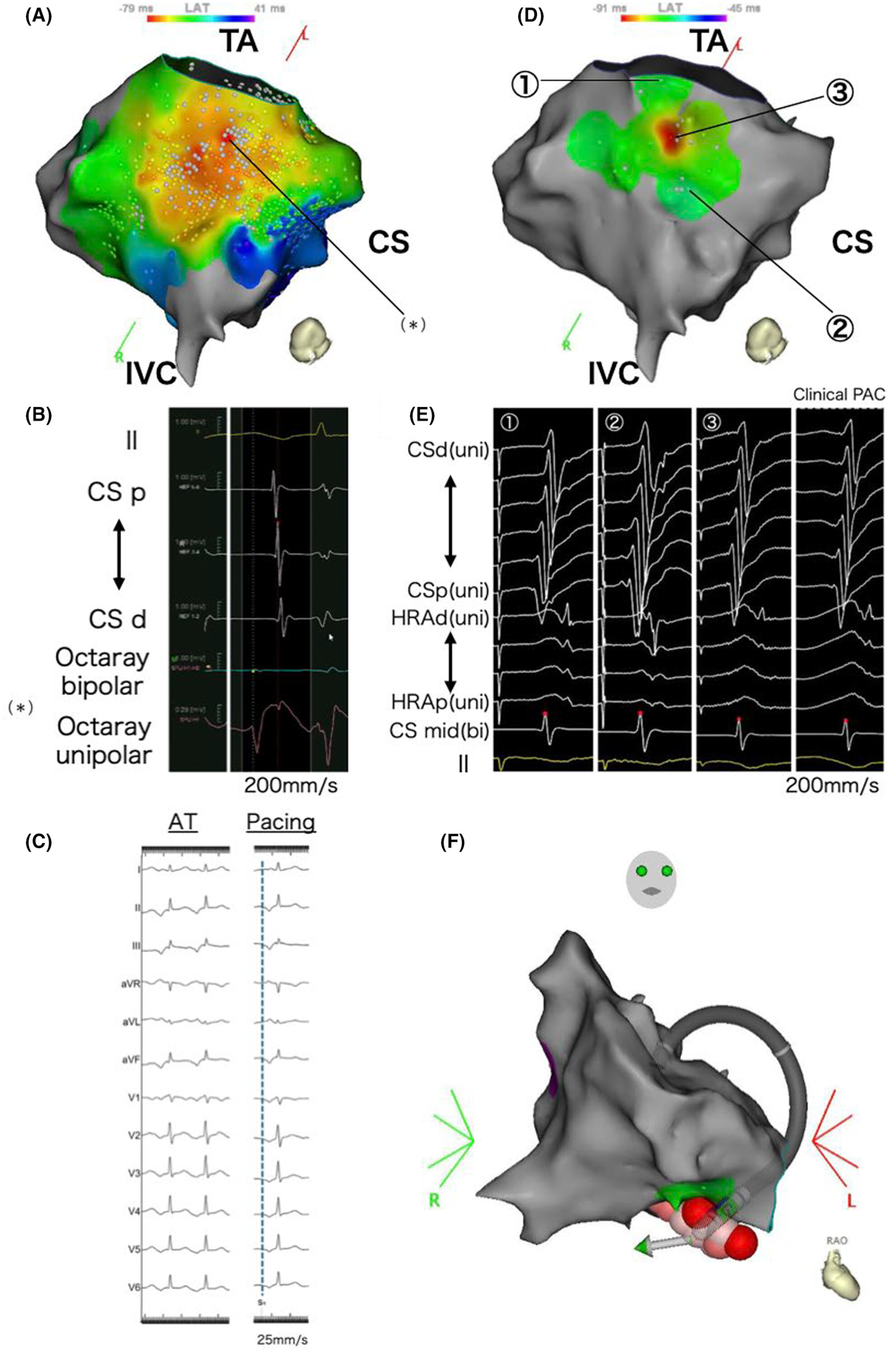 Utility of dual-chamber Electrogram-based pace mapping in a teenager with a focal atrial tachycardia, low inducibility, and indeterminate earliest excitation site