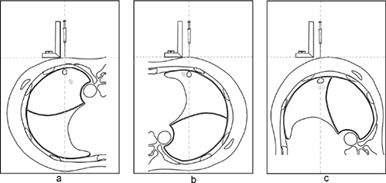 A novel technique for preoperative localization of pulmonary nodules using a mixture of tissue adhesive and iohexol under computed tomography guidance: A 140 patient single-center study
