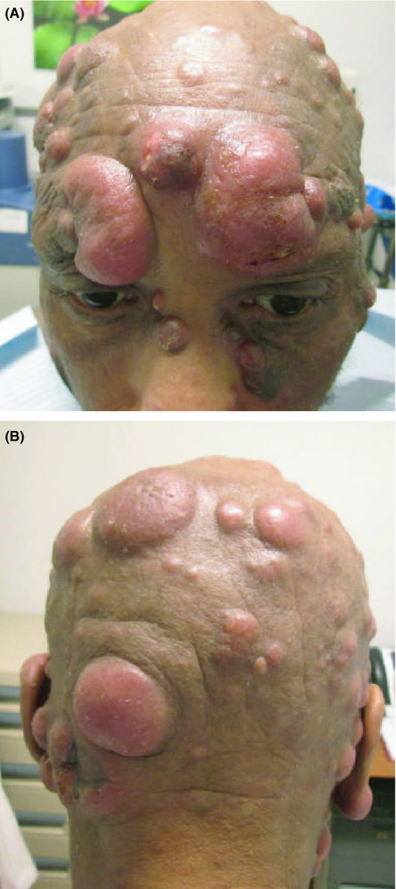 Cutaneous lymphocyte antigen expression loss and PD1 positivity in early cutaneous lesions of rapidly progressive mycosis fungoides