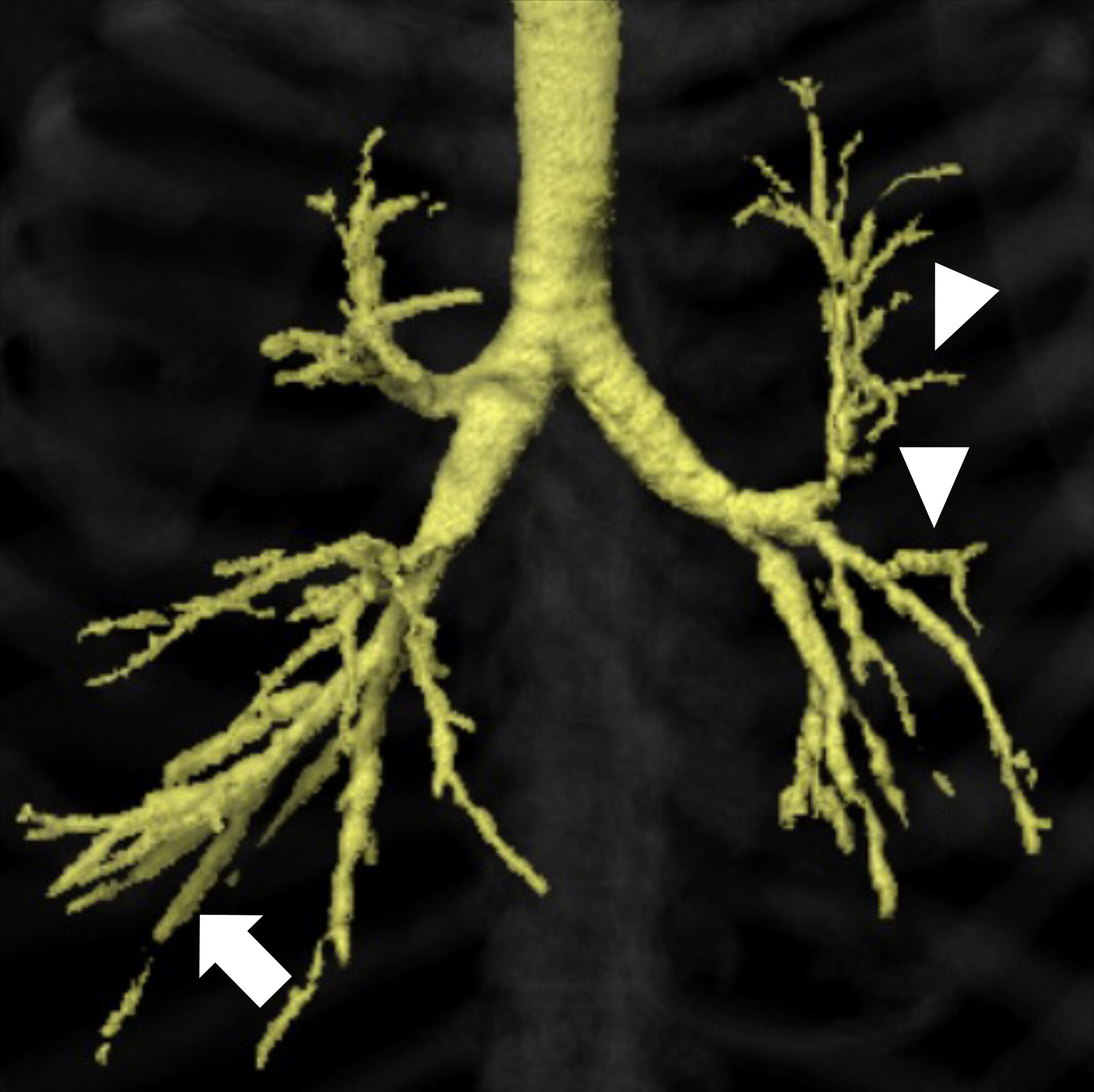 Bronchiolitis obliterans due to toxic epidermal necrolysis with structural evaluation using computed tomography bronchography: A case report