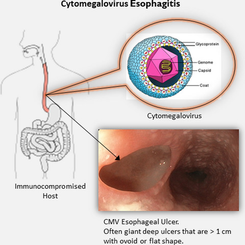 A 44-year-old man with esophageal ulcer