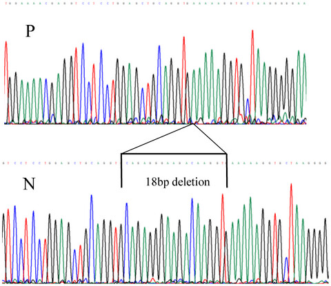 Inherited and de novo biallelic pathogenic variants in COL11A1 result in type 2 Stickler syndrome with severe hearing loss
