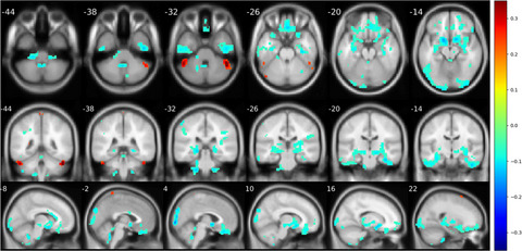 Modeling essential connections in obsessive–compulsive disorder patients using functional MRI