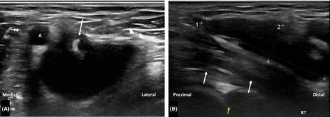 Bicipitoradial bursitis: A diagnosis challenge!