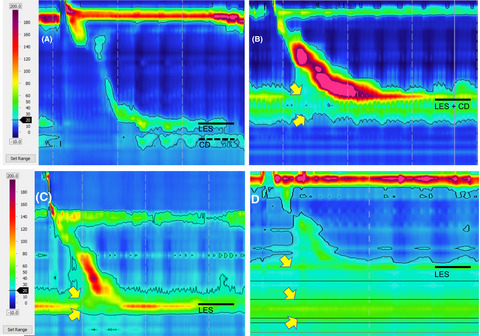 High-resolution manometry features of paraesophageal hernia
