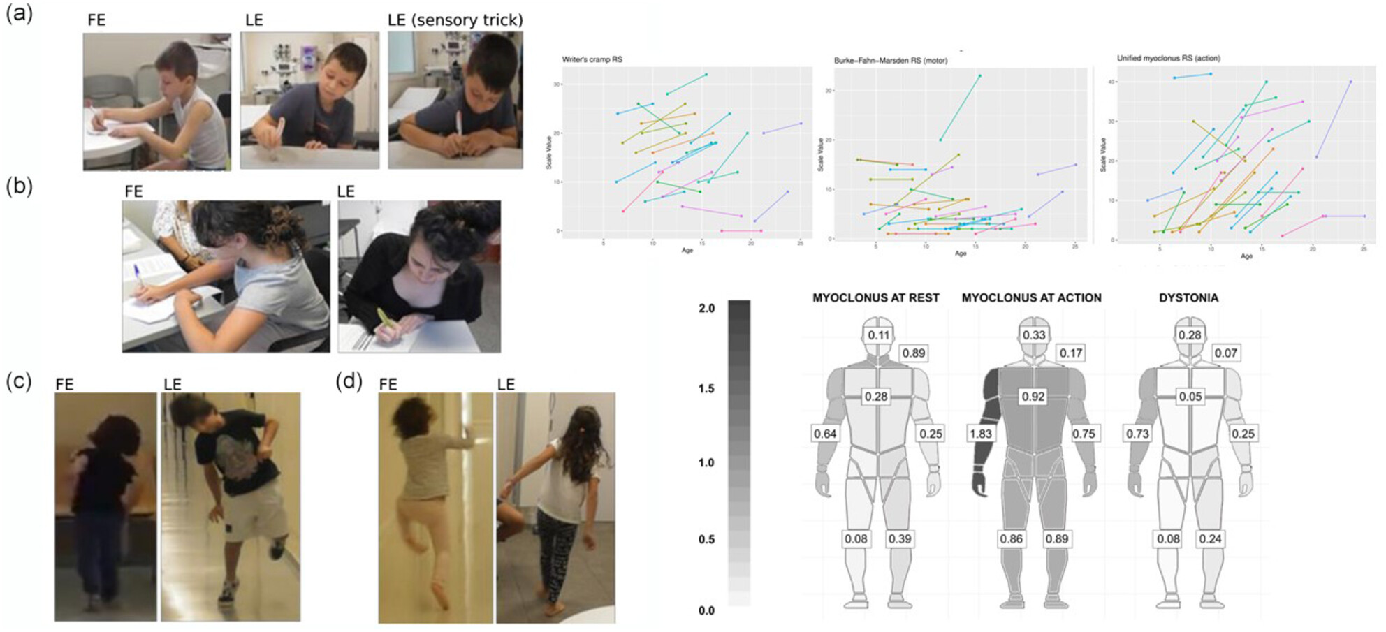 Historia natural de la distonía mioclónica asociada a variantes de SGCE en niños y adolescentes