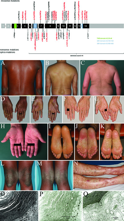 Mutation update for CYP4F22 variants associated with autosomal recessive congenital ichthyosis