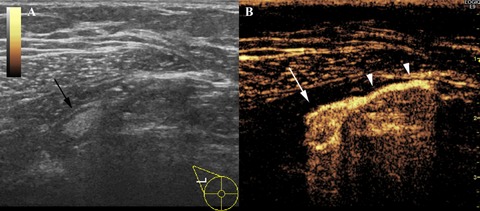 Identification of sentinel lymph nodes by contrast-enhanced ultrasonography with Sonazoid in patients with breast cancer: a feasibility study in three hospitals