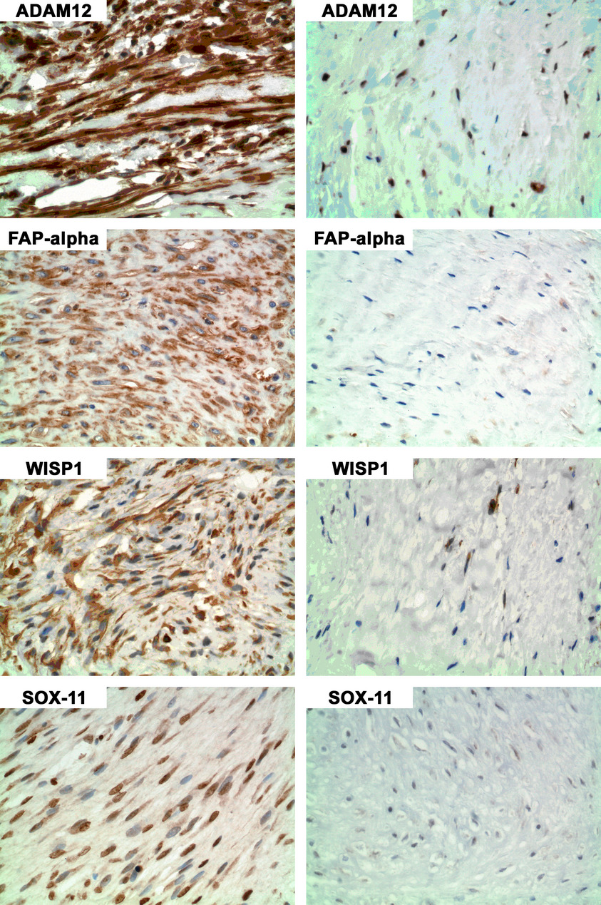 Expression of FAP, ADAM12, WISP1, and SOX11 is heterogeneous in aggressive fibromatosis and spatially relates to the histologic features of tumor activity