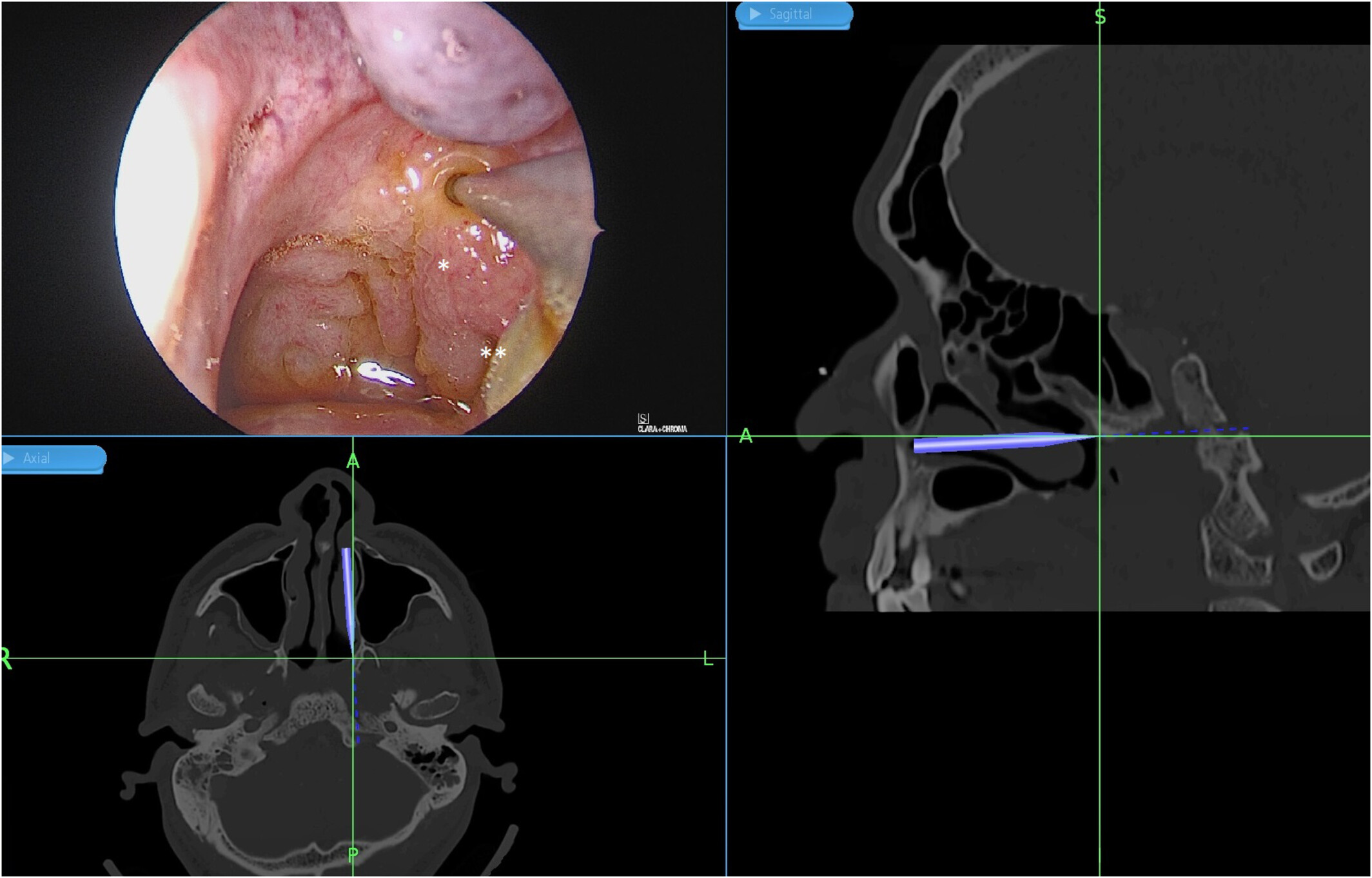 A case report of Transnasal Endoscopic Drainage for Upper Parapharyngeal Abscess