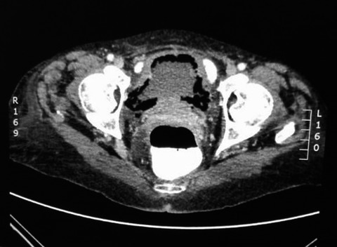 Emphysematous cystitis: A case report and literature review