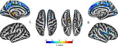 Early alterations in cortical morphology after neoadjuvant chemotherapy in breast cancer patients: A longitudinal magnetic resonance imaging study