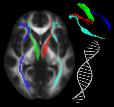 The effect of polygenic risk on white matter microstructural degeneration in Parkinson's disease: A longitudinal Diffusion Tensor Imaging study