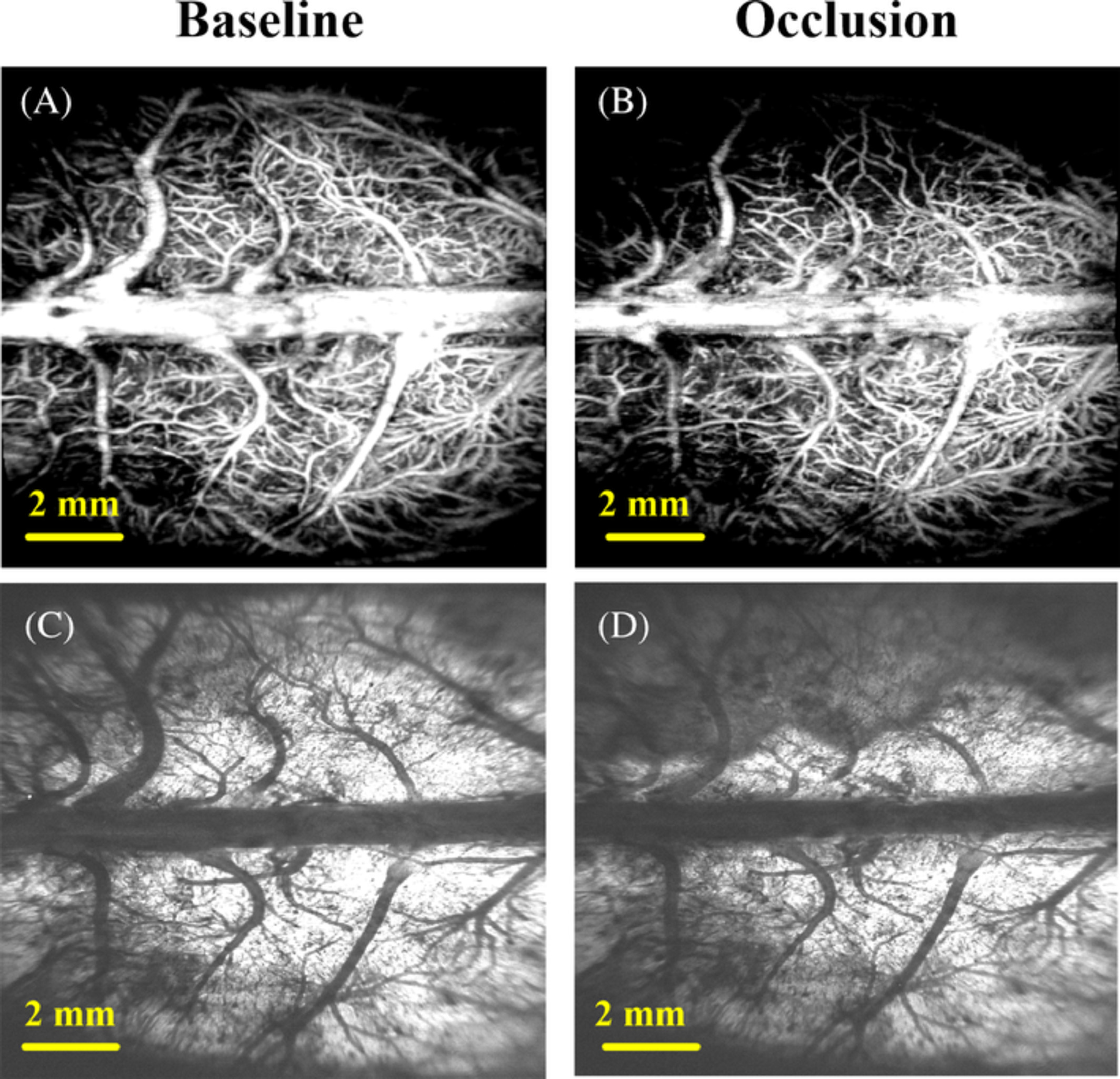 Simultaneous detection of cerebral blood perfusion and cerebral edema using swept-source optical coherence tomography