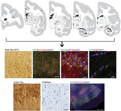 Expression of tau and phosphorylated tau in the brain of normal and hemiparkinsonian rhesus macaques