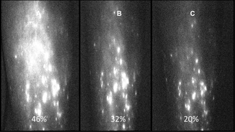 Indocyanine green near-infrared lymphangiography for evaluation of effectiveness of edema fluid flow under therapeutic compression
