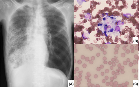 Combined hemophagocytic syndrome and thrombotic microangiopathy due to mixed infection with influenza virus and pneumococcal pneumonia