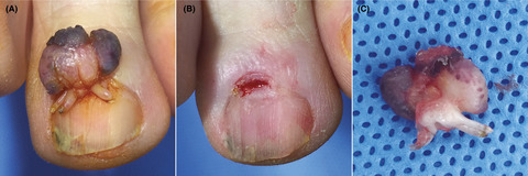 An unusual presentation of acquired periungual fibrokeratoma: A mixed form of dome-shaped and branching type