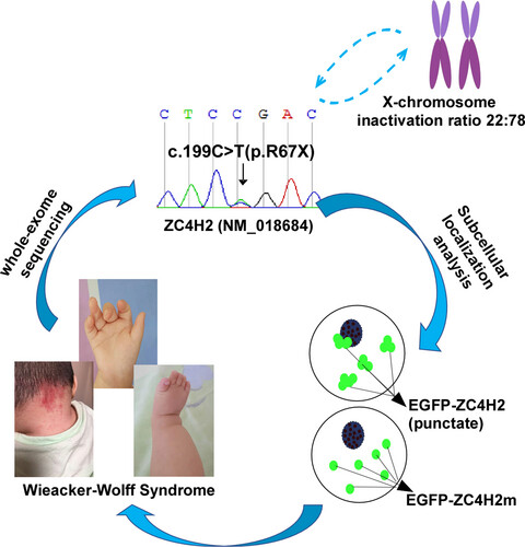 A novel de novo nonsense mutation in ZC4H2 causes Wieacker-Wolff Syndrome