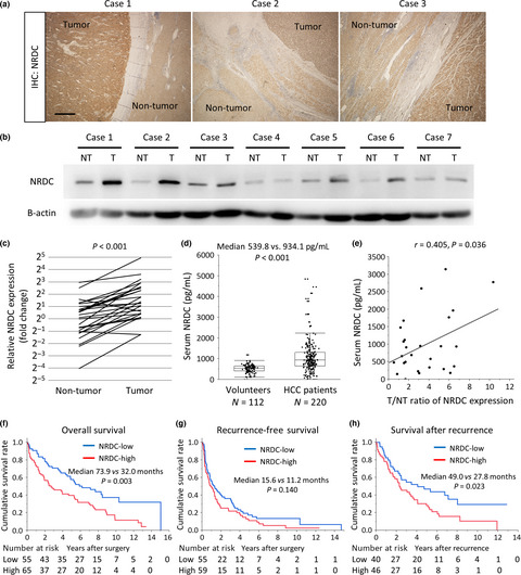 Nardilysin promotes hepatocellular carcinoma through activation of signal transducer and activator of transcription 3
