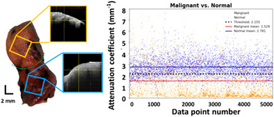 Intraoperative application of optical coherence tomography for lung tumor