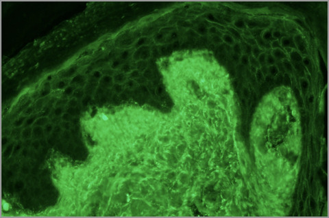 Clinical and direct immunofluorescence characteristics of cutaneous toxicity associated with enfortumab vedotin