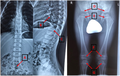 Clinical and genetic characterization of autosomal recessive stickler syndrome caused by novel compound heterozygous mutations in the COL9A3 gene