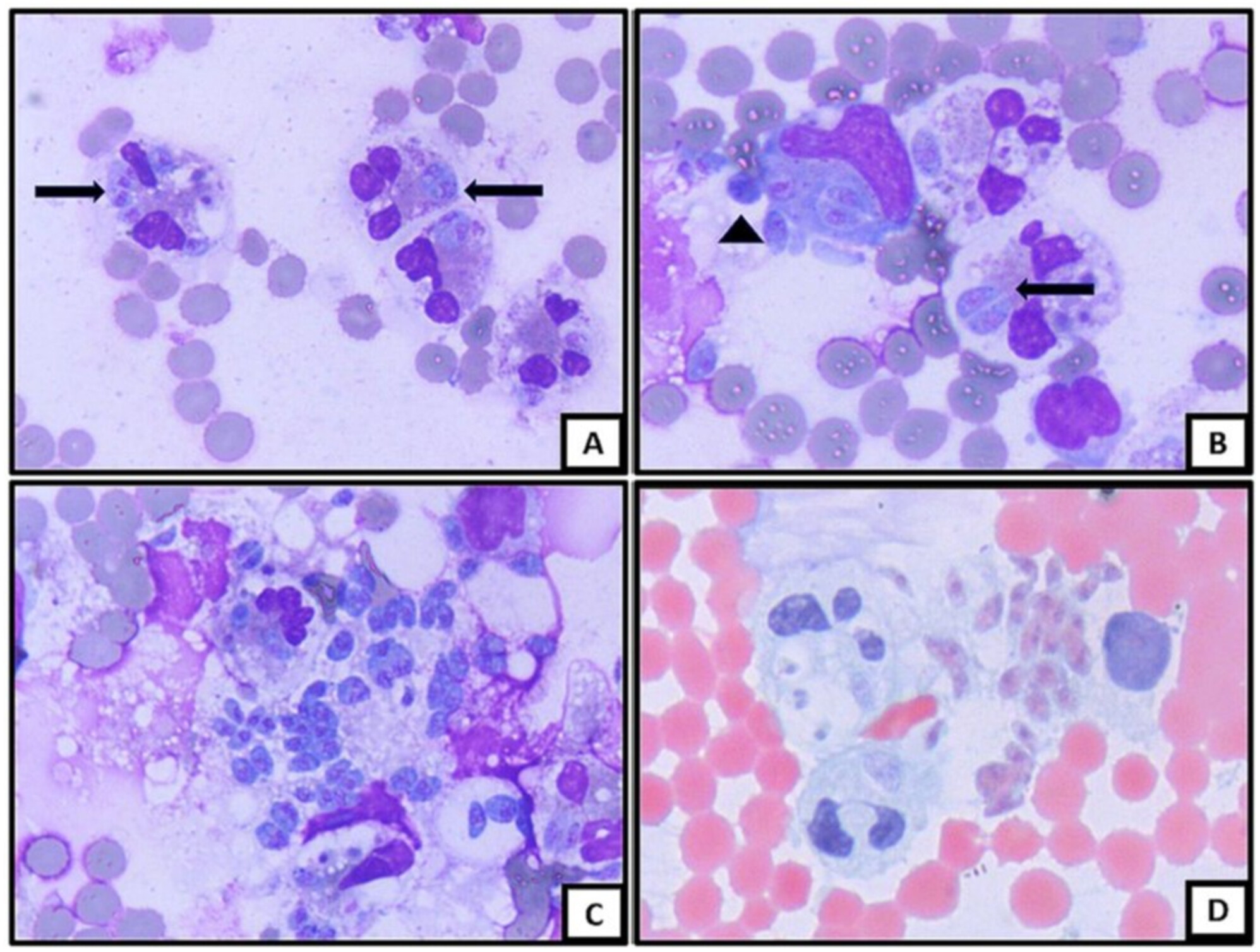 Detection of Toxoplasma Gondii Tachyzoites in Cerebrospinal Fluid: Once in a Blue Moon Finding