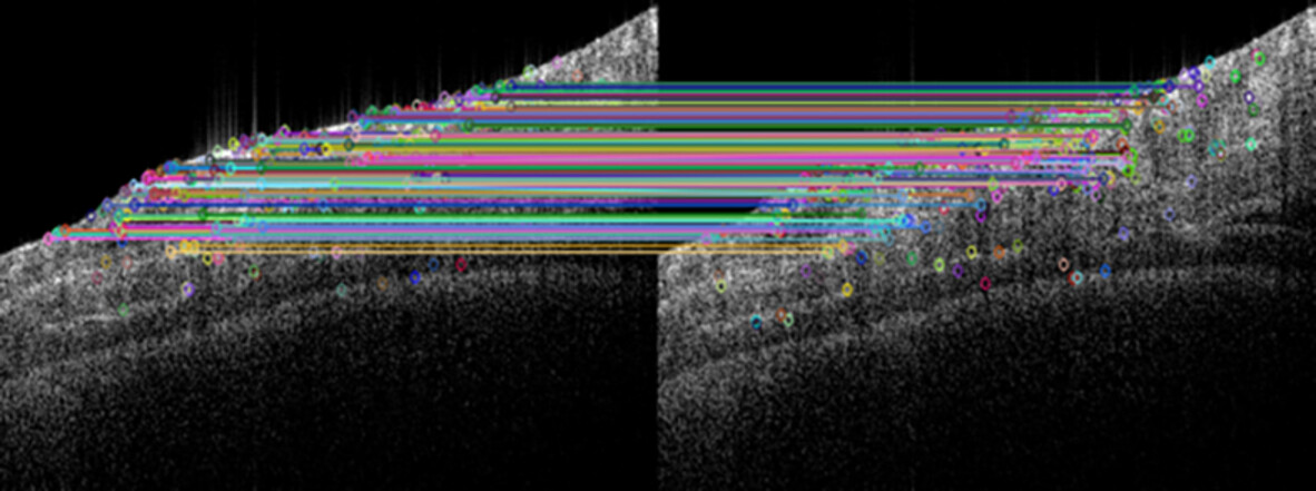 Motion Artifact Correction for OCT Microvascular Images Based on Image Feature Matching