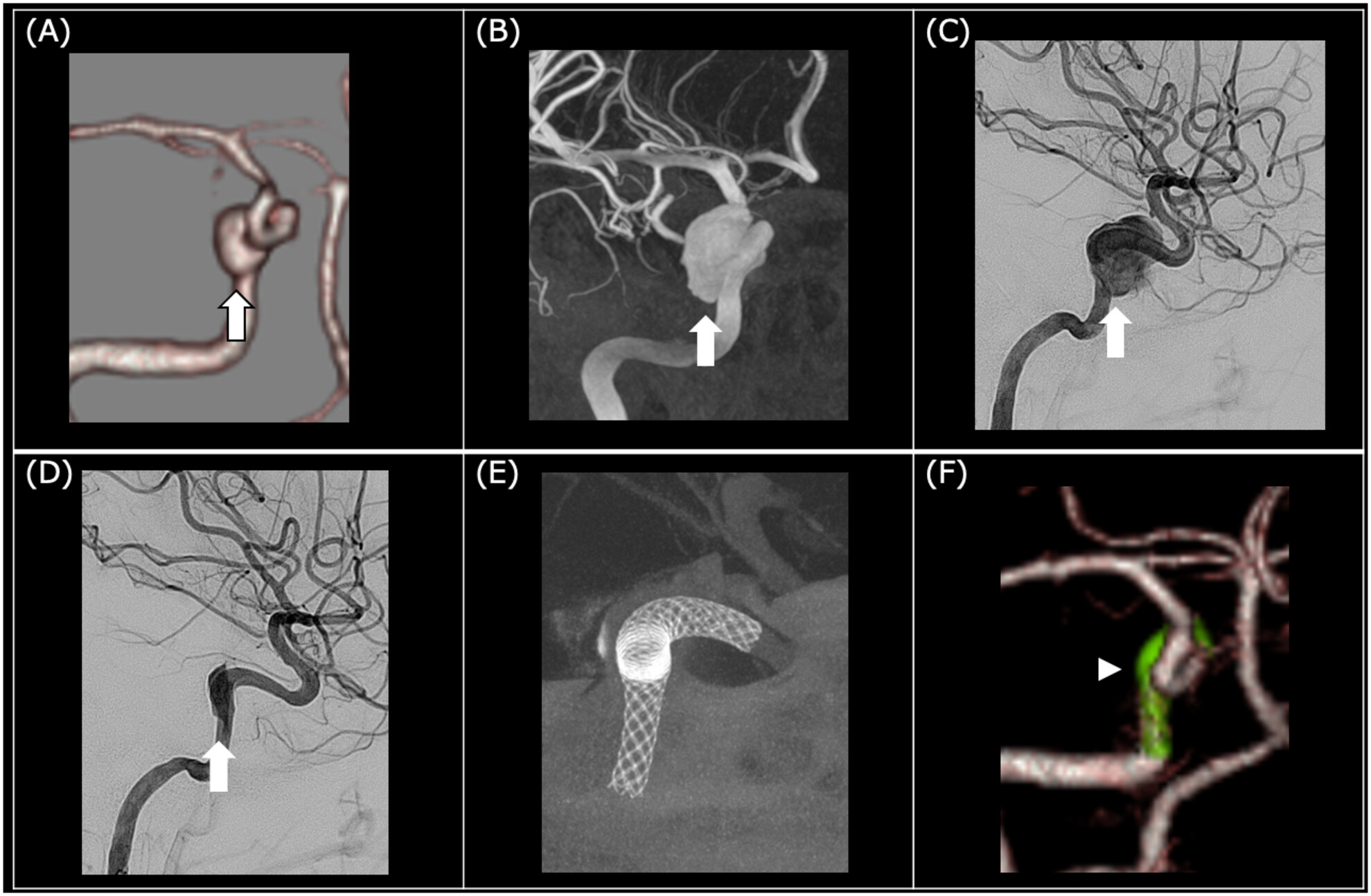 Traumatic internal carotid artery aneurysm distant from facial bone fractures treated with a flow diverter stent: A case report