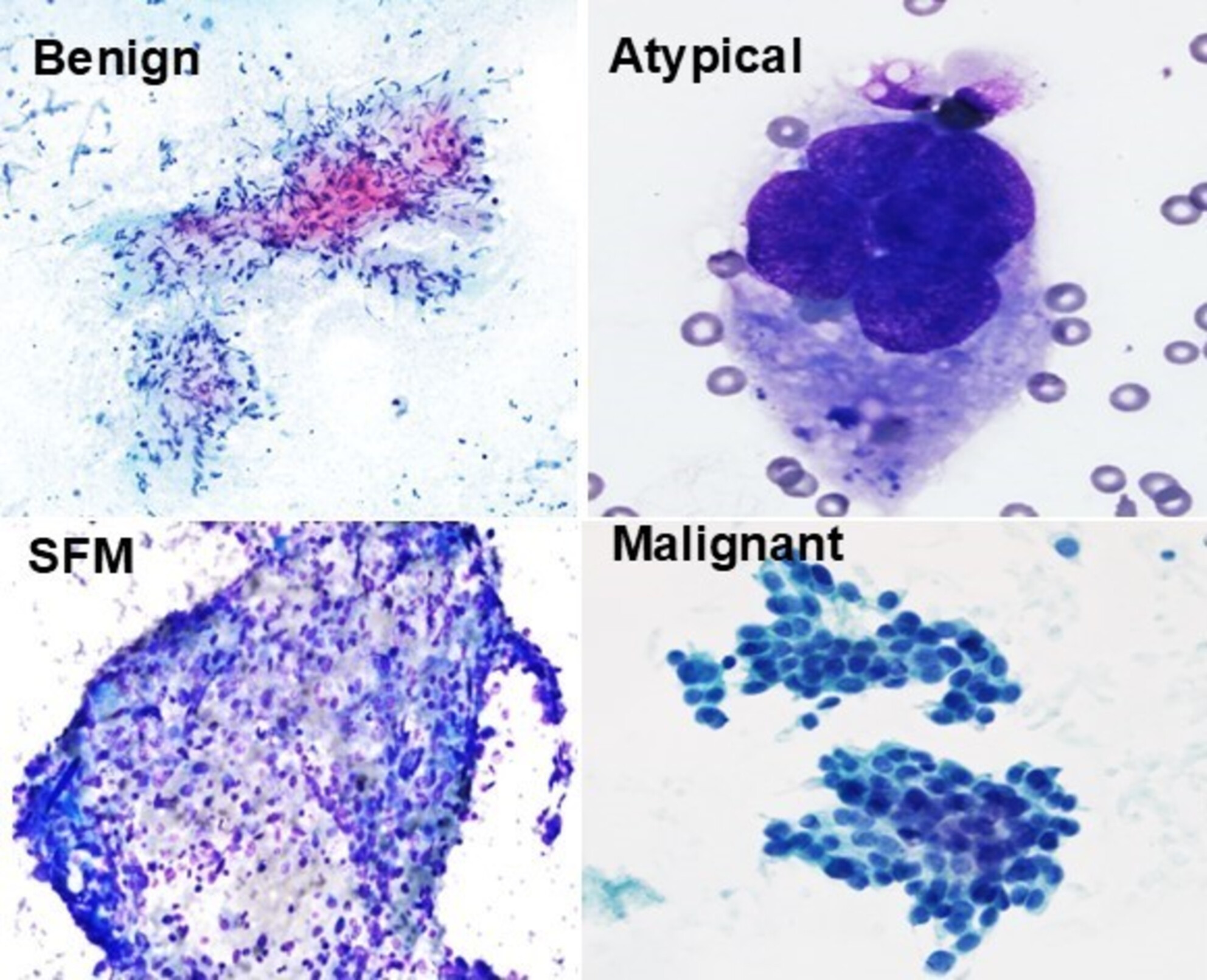 An Institutional Experience in Lung Endobronchial Ultrasound-Guided Fine Needle Aspiration: Comparing Risk of Malignancy With WHO Reporting System for Lung Cytopathology