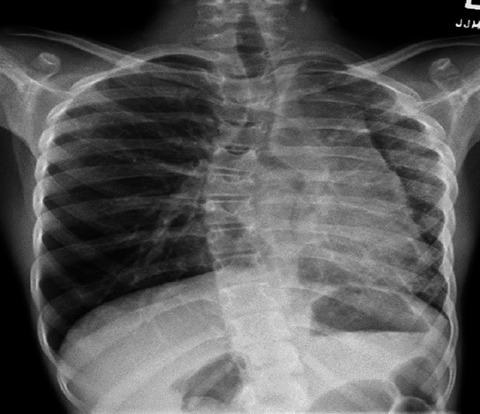 Left hypoplastic lung and hemoptysis—rare familial unilateral pulmonary vein atresia