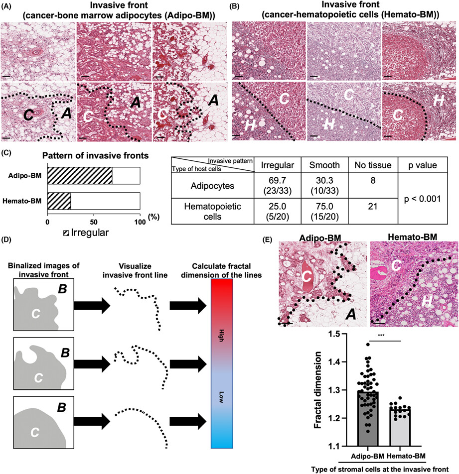 Bone marrow adipocytes induce cancer-associated fibroblasts and immune evasion, enhancing invasion and drug resistance