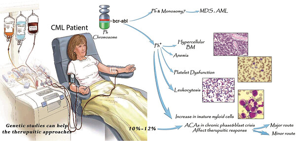 Chronic myeloid leukemia with complex karyotypes: Prognosis and therapeutic approaches