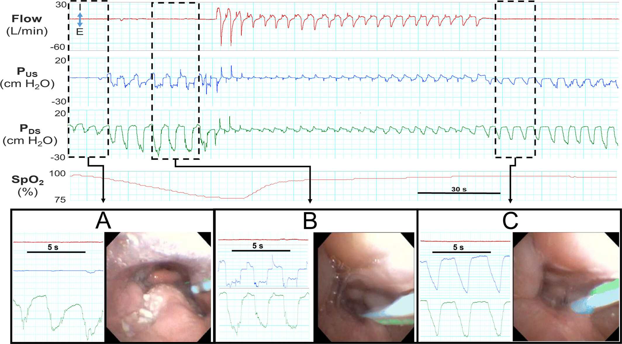 The Whimsical Nature of Airway Obstruction during Drug-Induced Sleep Endoscopy