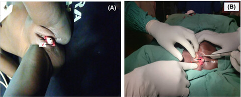 Urinary bladder cavernous hemangioma in a 3-year-old: A rare case report