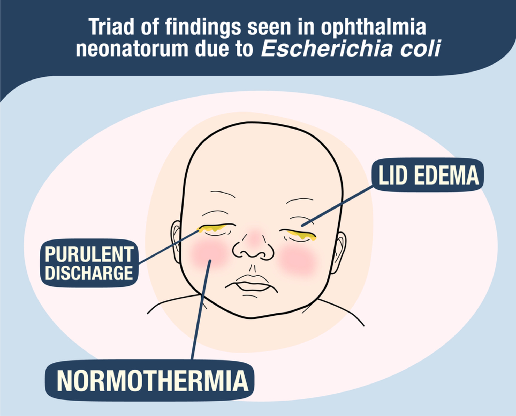 Ophthalmia neonatorum due to Escherichia coli: A rare cause or an emerging bacterial etiology of neonatal conjunctivitis?