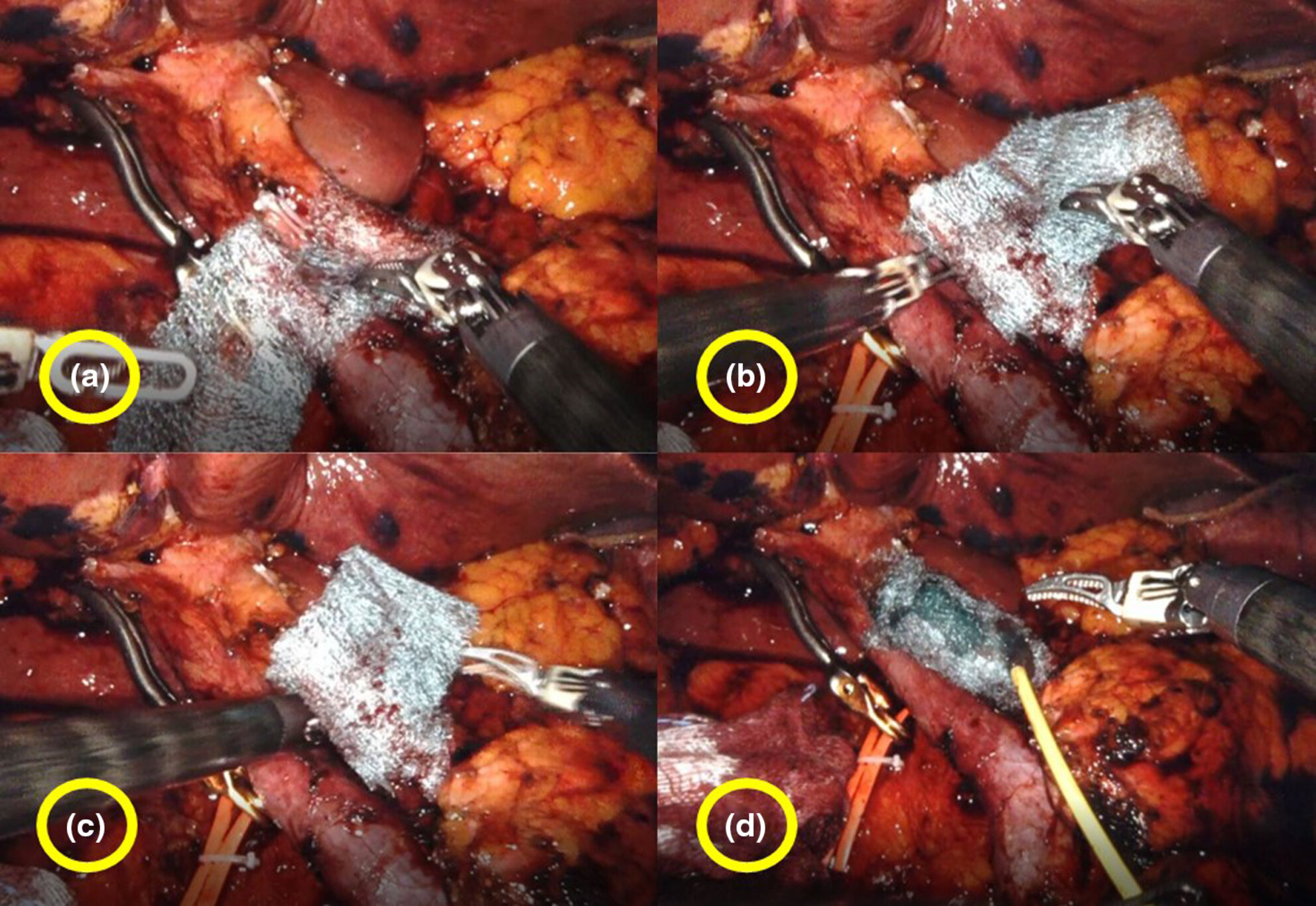 Hepatic artery protection using a polyglycolic acid sheet during pancreaticoduodenectomy: A multicenter study