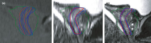 Visualising the urethra for prostate radiotherapy planning