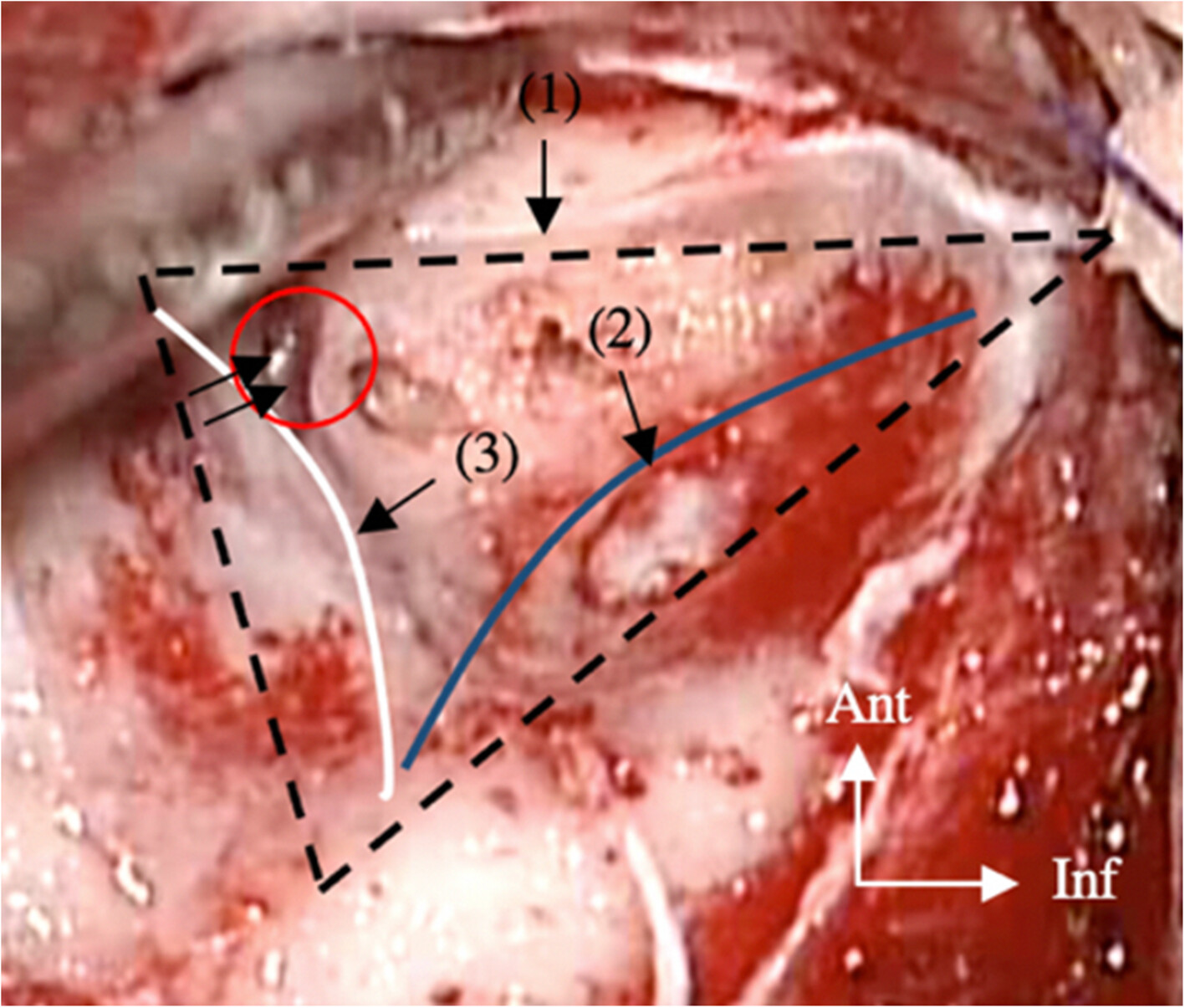 The Petrosquamosal Sinus: A Rare Vascular Variant Encountered During Cochlear Implantation Surgery